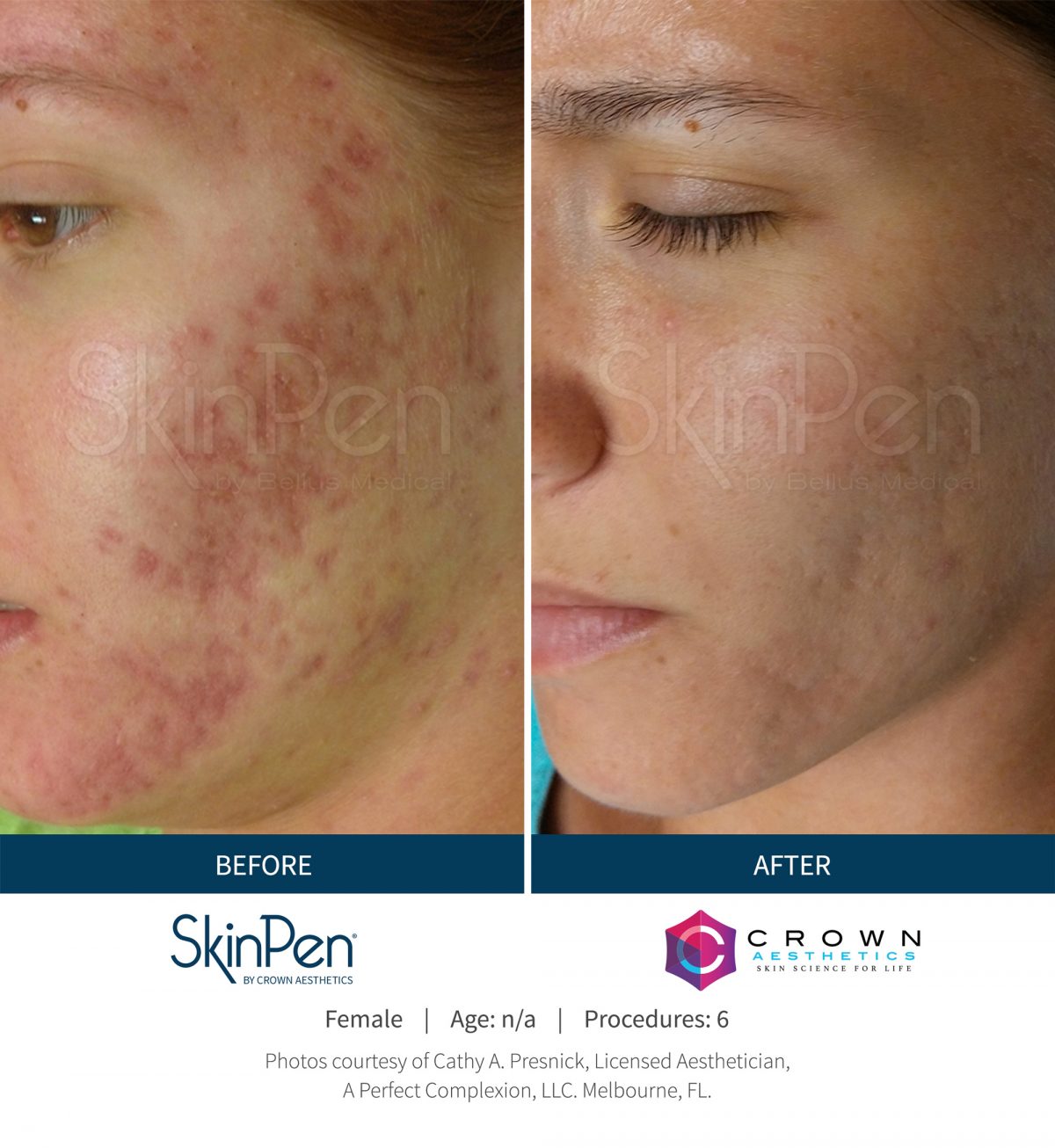 SkinPen Before And After SkinPen Microneedling Crown Aesthetics