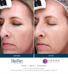 microneedling before and after SkinPen patient 14