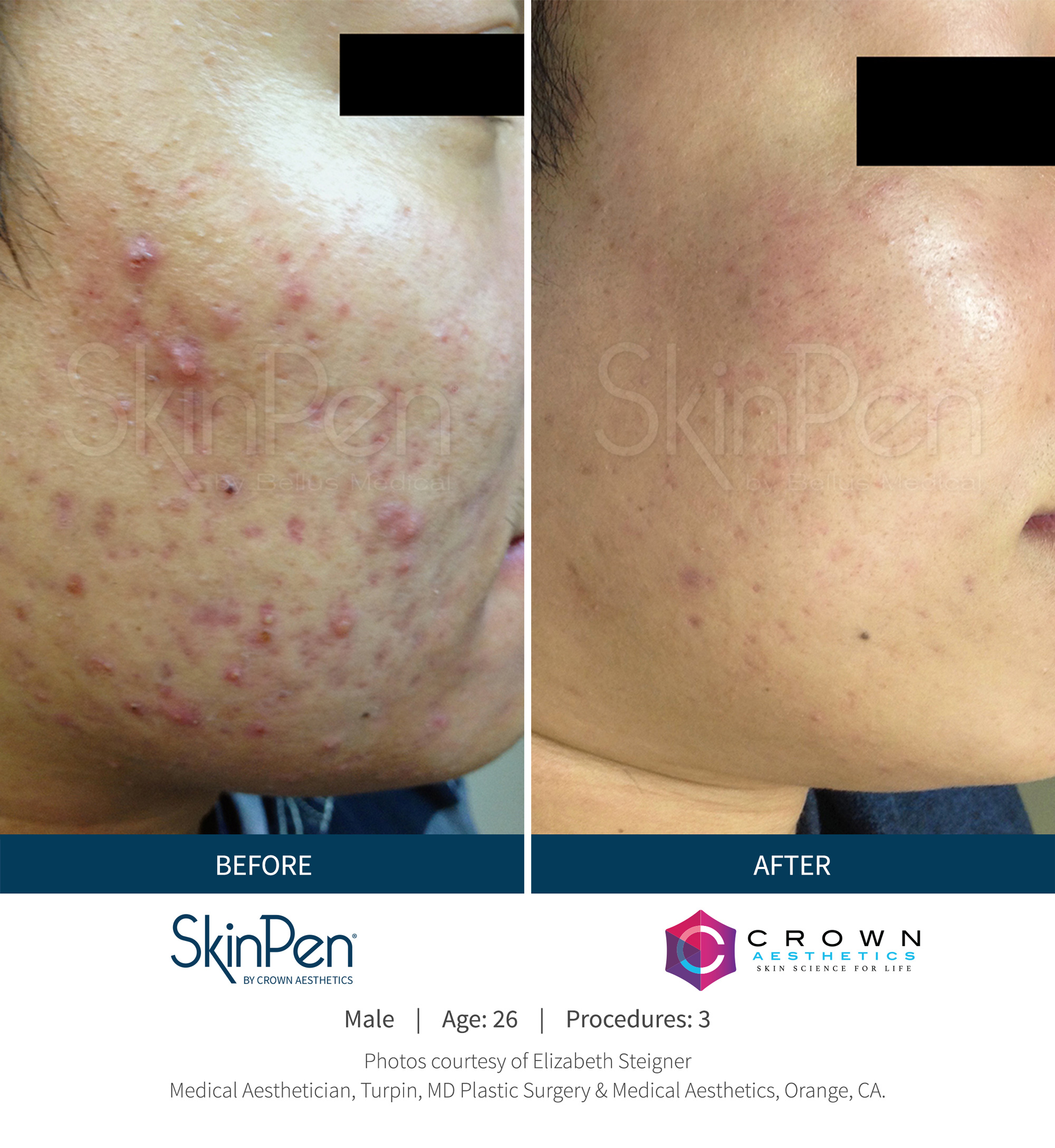 SkinPen before and after picture microneedling