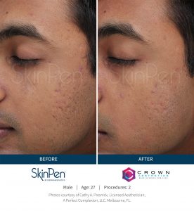 microneedling before and after SkinPen patient 16