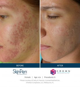 microneedling before and after SkinPen patient 12
