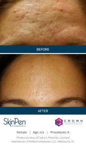 microneedling before and after SkinPen patient 11