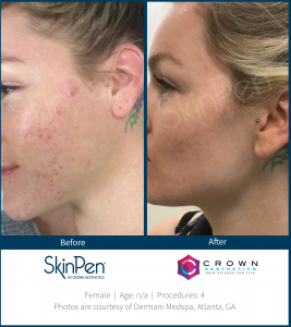 microneedling before and after SkinPen patient 5