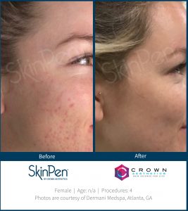 microneedling before and after SkinPen patient 4