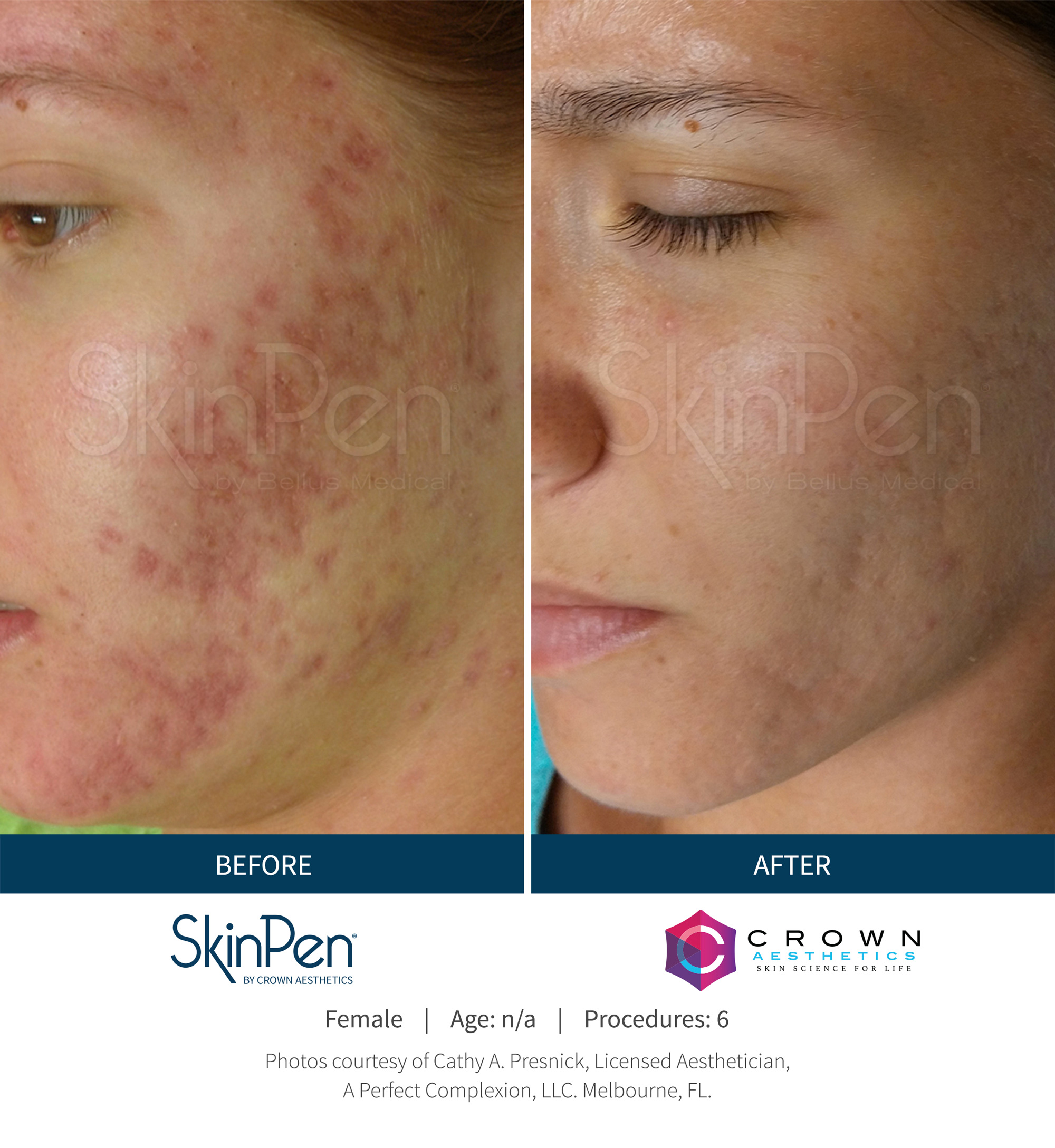 SkinPen Microneedling Fight Facial Acne Scars Crown Aesthetics